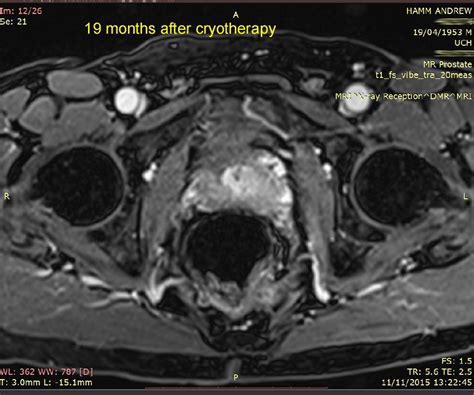 Andys Prostate Blog Details From Focal Therapy To Radical