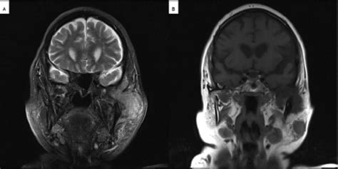 Scielo Brasil Pleomorphic Adenoma Of The Parotid Gland Presenting