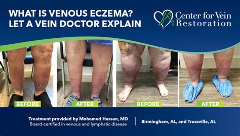 What is Venous Eczema? Let a Vein Doctor Explain