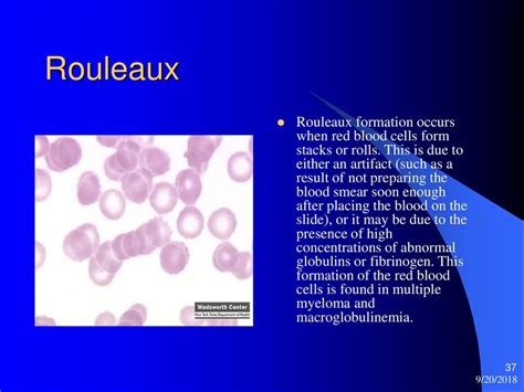 Hematology 425 Anemias RBC Morphology Approach To Diagnosis Ppt