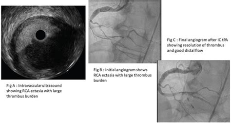 Intracoronary Thrombolysis For Rescue Of Refractory Large Thrombus