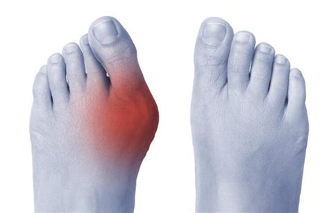 Gout Vs Bunions Key Differences And How To Deal With Gout And Bunions