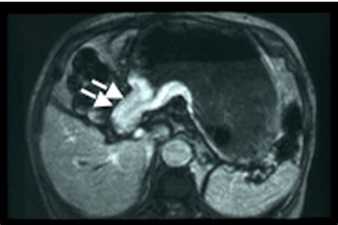 Mr Imaging Of Gastric Carcinoma Intechopen