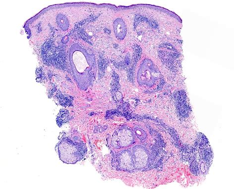 Lupus Pernio Histology