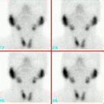 Cintilografia De Gl Ndulas Salivares Medicina Nuclear E Radiologia