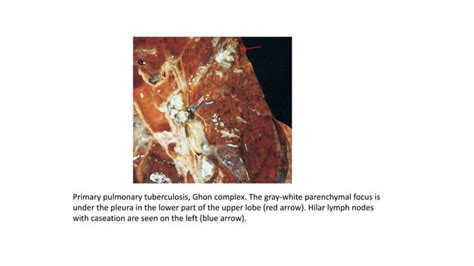 Tuberculosis histology pictures explained.pptx