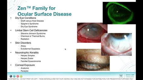 Finding Zen For Ocular Surface Disease Youtube