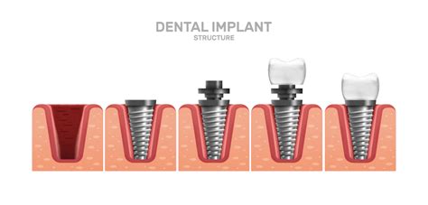 Dental Implant Placement Dr Shervin Molayem Periodontist Implant