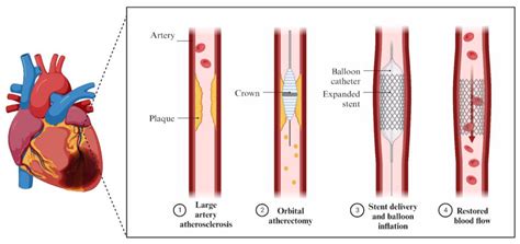 Jcm Free Full Text Rotational Atherectomy Orbital Atherectomy And