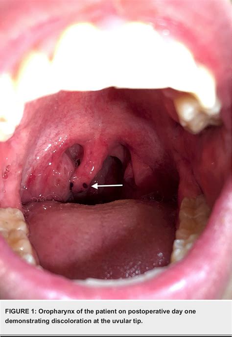 Figure 1 From Uvular Necrosis After Shoulder Surgery A Report Of Three
