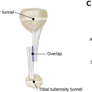 Schematic Diagram Of The Lengthening Method A The Patellar Tendon Was