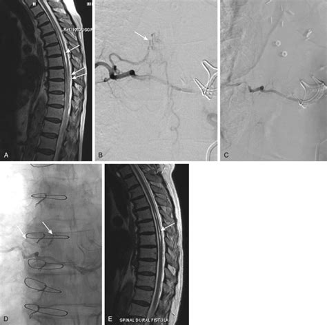 Spinal Dural And Extradural Vascular Malformations Neupsy Key