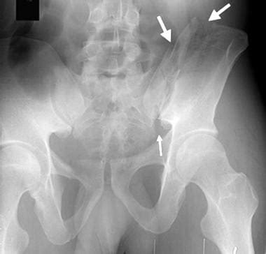 Pelvic Fracture X Ray