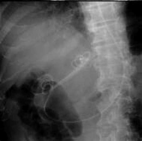 Fluoroscopic Image Showing Double Pigtail Stents And Nasocystic