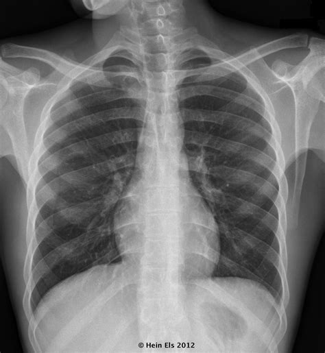 Radiologyiq Normal Cxr