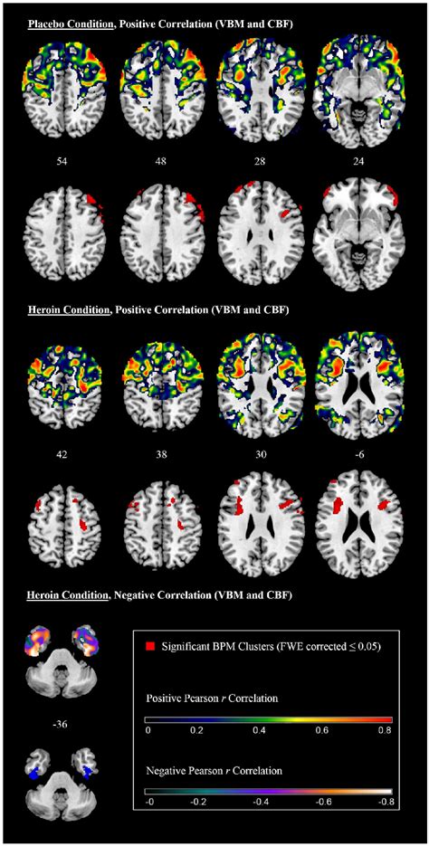 Correlation Between Gray Matter Volume And Perfusion Axial Slices