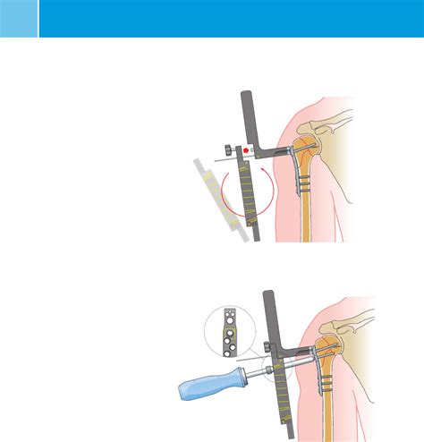 Ncb Proximal Humerus Surgical Technique System