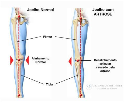 Como Saber Se O Joelho Saiu Do Lugar - Osteotomias do Joelho: Entenda o Que São e Como Elas Podem Melhorar a ...