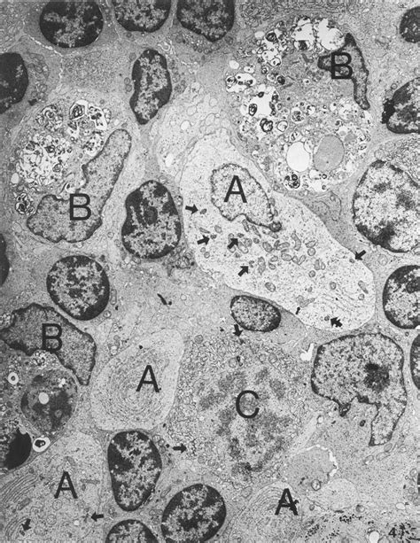 Low Power Electron Micrograph Of Representative Focal Lesion Consisting