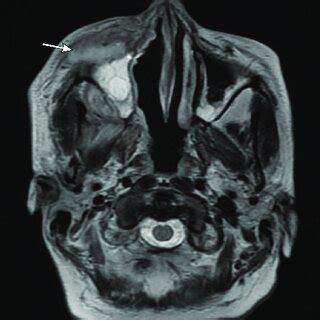 B Corresponding Axial T2 Weighted MR Image Shows Signal Intensity