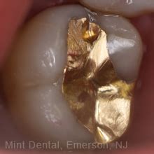 Inlays and Onlays | Mint Dental - Emerson, NJ | Bergen County Dentist