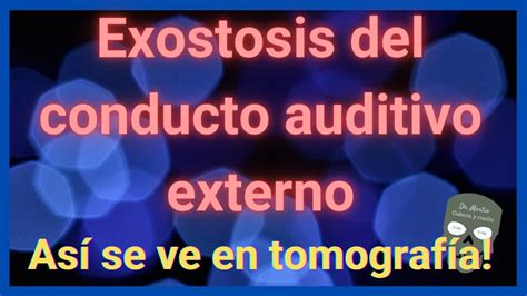 Exostosis del conducto auditivo externo TOMOGFRAFÍA YouTube