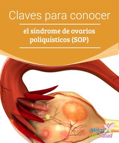 Claves para conocer el síndrome de ovarios poliquísticos SOP