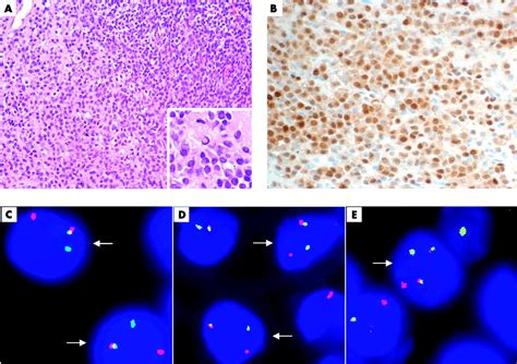 Pulmonary Mucosa Associated Lymphoid Tissue Lymphoma With Strong