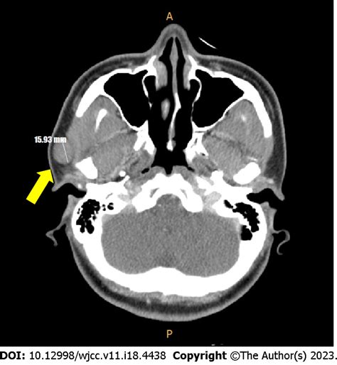 Removal Of Unexpected Schwannoma With Superficial Parotidectomy Using