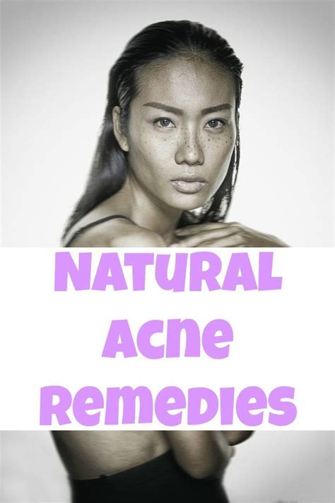 These Are Some Awesome Tips To Get Rid Of Acne Naturally Chest Acne Acne Remedies Natural