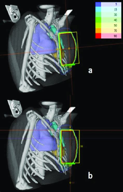 Isodose Curves In The Medial Tangent Beam A The Dual Isocentric