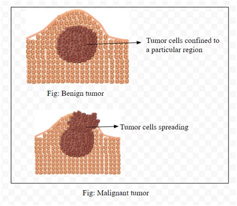 Differentiate between benign tumor and malignant tumor.