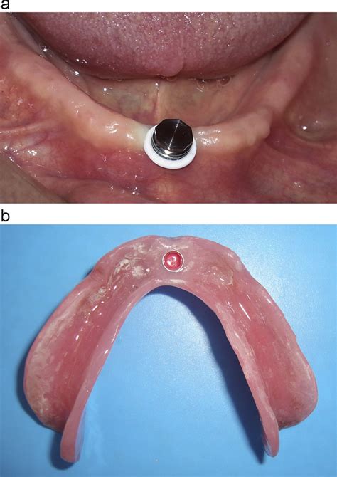 A Pick Up Procedure In The Single Implant Group B Metal Housing