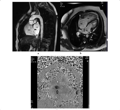 Phase Contrast Cmr Images Depicting Asd Arrow Heads In Oblique