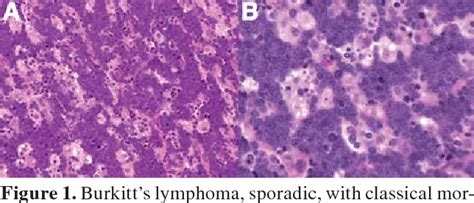 Table 1 From Burkitt S Lymphoma Clinicopathologic Features And Differential Diagnosis