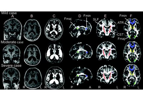 Magnetic Resonance Images From Three Idiopathic Normal Pressure Download Scientific Diagram