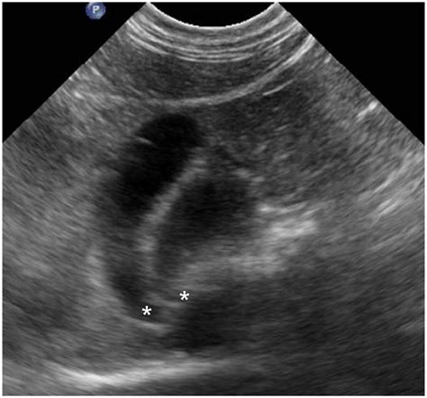 Ultrasonographic Prevalence And Proposed Morphologic Classification Of