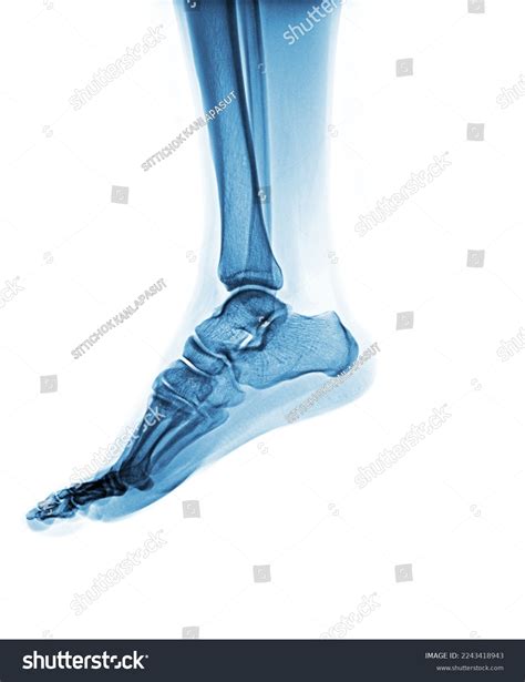 Xray Normal Human Foot Lateral View Stock Photo Shutterstock