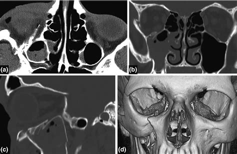 Dose Reduction In Ct Imaging For Facial Bone Trauma In Adults A