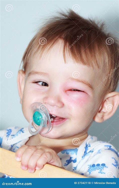 Newborn with red eye stock photo. Image of bacteria, medical - 27342118