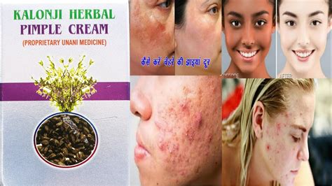 Mohammedia Kalinji Herbal Pimple Cream Kalonji Herbal Pimple Screen