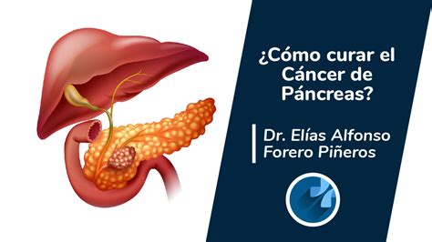 Cáncer De Páncreas ¿cómo Curarlo Dr Elías Alfonso Forero