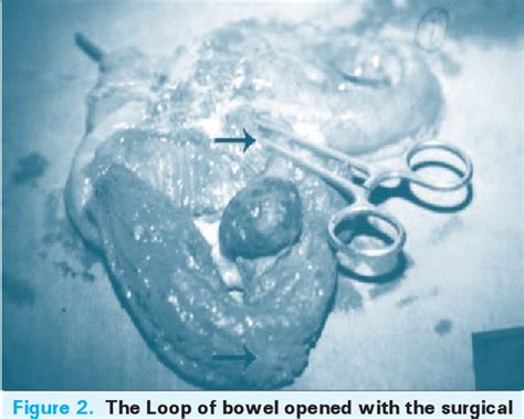 Figure 2 From Intraluminal Migration Of Gossypiboma Without Intestinal