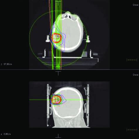 Hypofractionated Stereotactic Radiotherapy Treatment With Volumetric