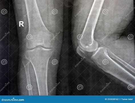 Plain X Ray of the Right Knee Shows Apparent Joint Osteoarthritis According To Kellgren and ...