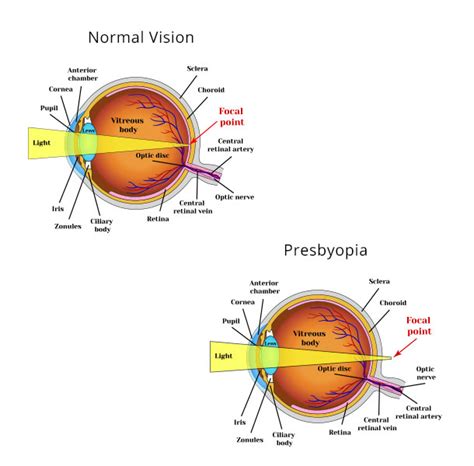 Contact Lens For Presbyopia Astigmatism And Cataracts What You Should