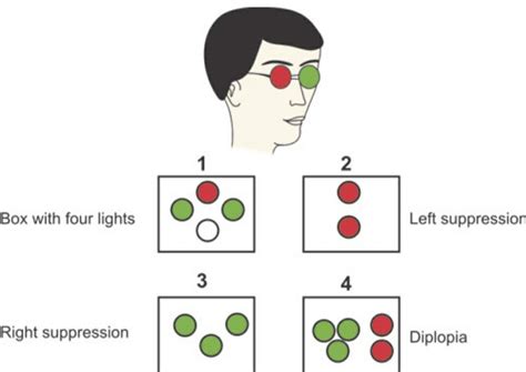 Diplopia Double Vision Physiological And Pathological Optography