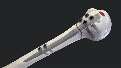 Arthrex Humeral Nail System Surgical Technique