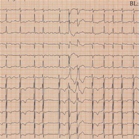 Preprocedural 12 Lead Electrocardiogram Atrial Fibrillation With Rapid