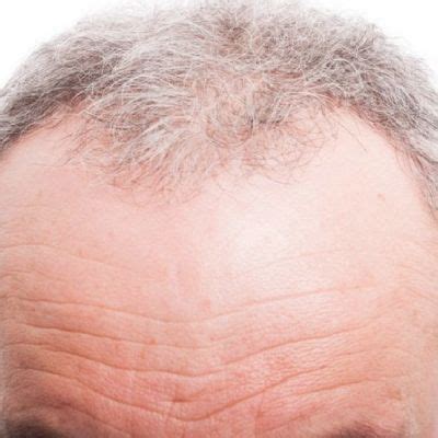 Forehead Hair loss: Signs & Causes - AHS India